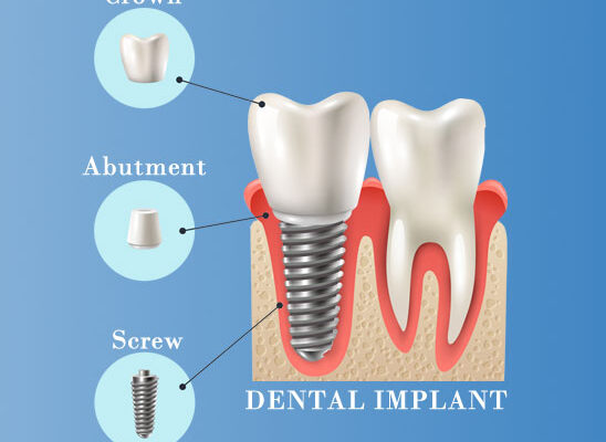 implant-img